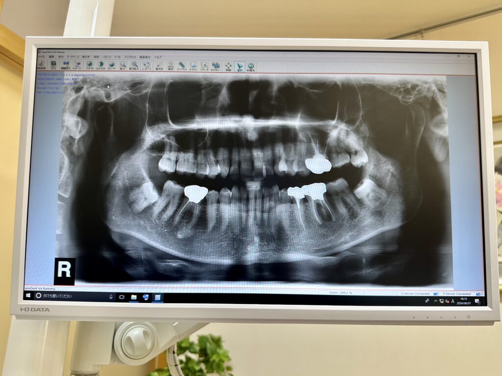 歯のレントゲン