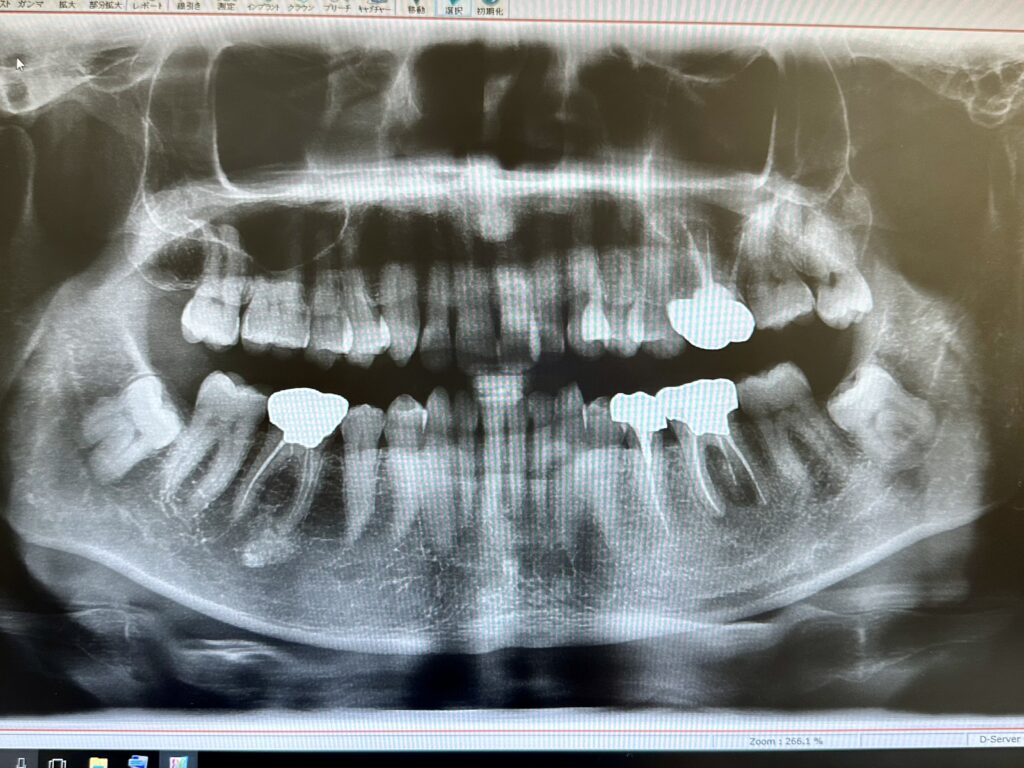 歯のレントゲン