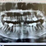 歯のレントゲン