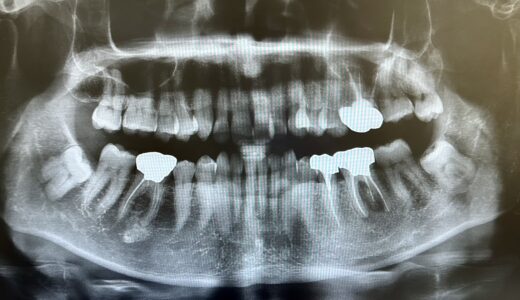 歯のレントゲン